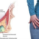 Illustration for article titled Obat Fistula Ani Tradisional